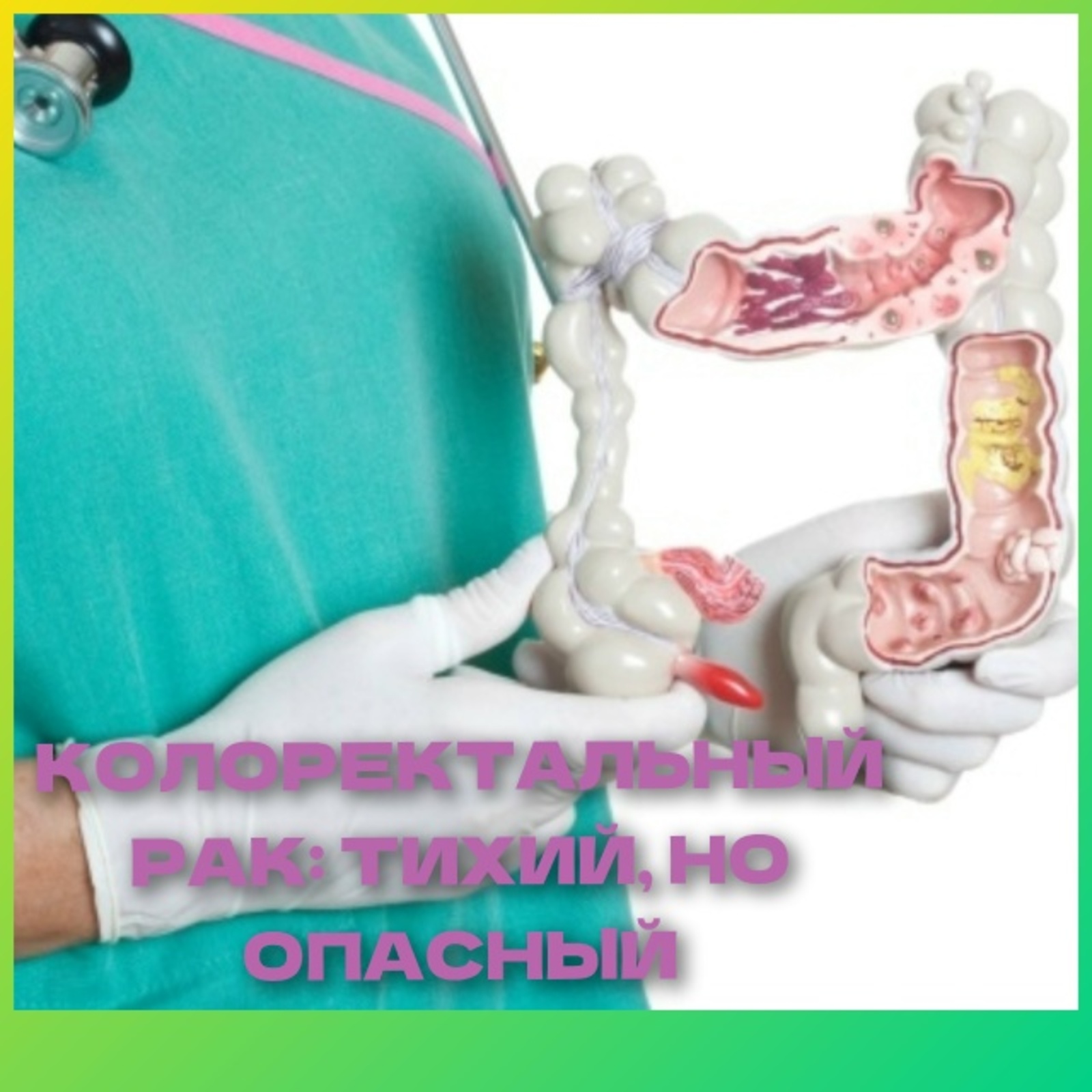 Колоректальный рак: тихий, но опасный